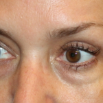 Blepharoplasty Before & After Patient #30581