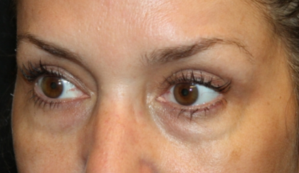 Blepharoplasty Before & After Patient #30581