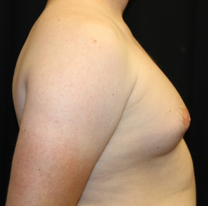 Gynecomastia Before & After Patient #30625