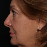 Facelift Before & After Patient #30487