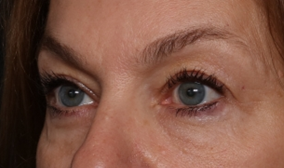 Blepharoplasty Before & After Patient #30512