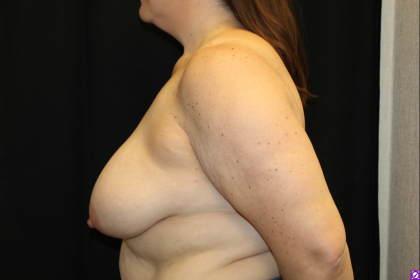 Breast Reduction Before & After Patient #30541