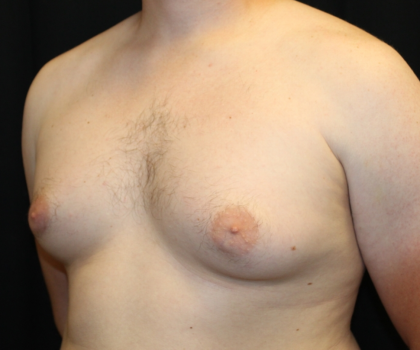 Gynecomastia Before & After Patient #30625