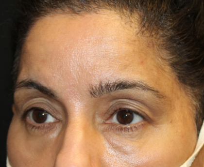 Brow Lift Before & After Patient #30678