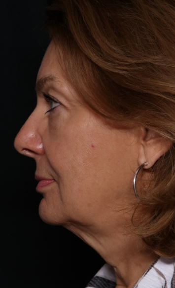 Facelift Before & After Patient #30487