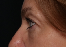 Blepharoplasty Before & After Patient #30512