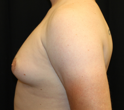 Gynecomastia Before & After Patient #30625