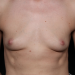 Breast Augmentation - Round Silicone Implants Before & After Patient #30658