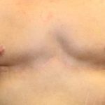 Gynecomastia Before & After Patient #30552