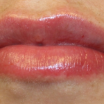 Lip Filler Before & After Patient #30569