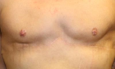 Gynecomastia Before & After Patient #30552