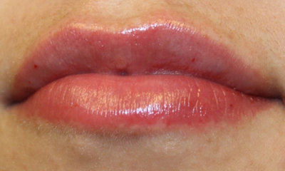 Lip Filler Before & After Patient #30569