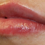 Lip Filler Before & After Patient #30569