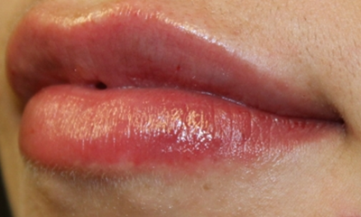 Lip Filler Before & After Patient #30569