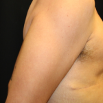 Gynecomastia Before & After Patient #30552