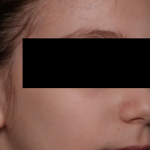 Otoplasty Before & After Patient #30478