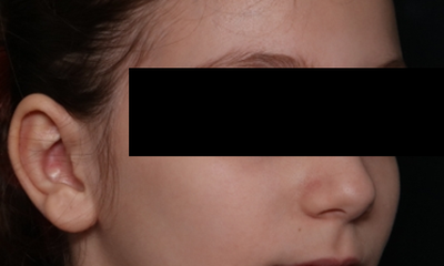 Otoplasty Before & After Patient #30478