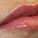 Lip Filler Before & After Patient #30569