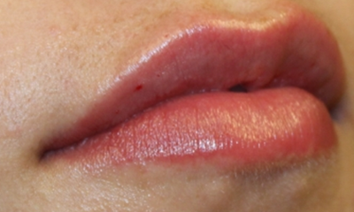 Lip Filler Before & After Patient #30569