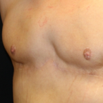 Gynecomastia Before & After Patient #30552