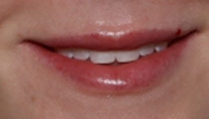 Lip Filler Before & After Patient #30588