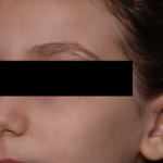 Otoplasty Before & After Patient #30478