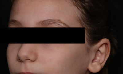 Otoplasty Before & After Patient #30478