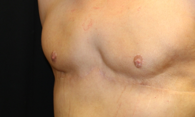 Gynecomastia Before & After Patient #30552