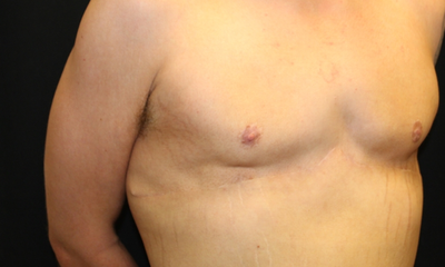 Gynecomastia Before & After Patient #30552