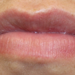 Lip Filler Before & After Patient #30569