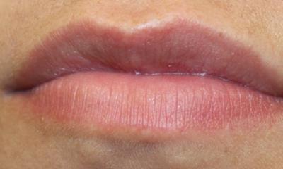 Lip Filler Before & After Patient #30569