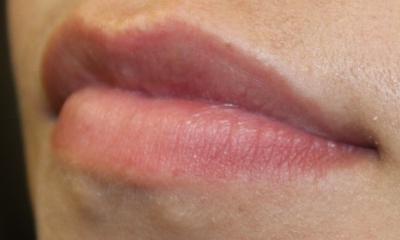 Lip Filler Before & After Patient #30569