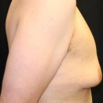 Gynecomastia Before & After Patient #30552