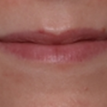 Lip Filler Before & After Patient #30588