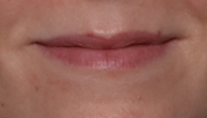 Lip Filler Before & After Patient #30588