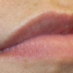 Lip Filler Before & After Patient #30569
