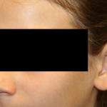 Otoplasty Before & After Patient #30478