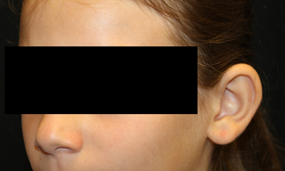 Otoplasty Before & After Patient #30478