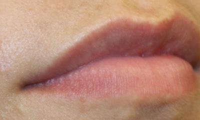 Lip Filler Before & After Patient #30569