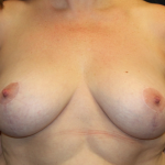 Breast Reduction Before & After Patient #30667