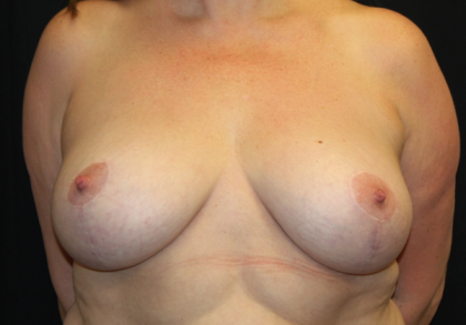 Breast Reduction Before & After Patient #30667