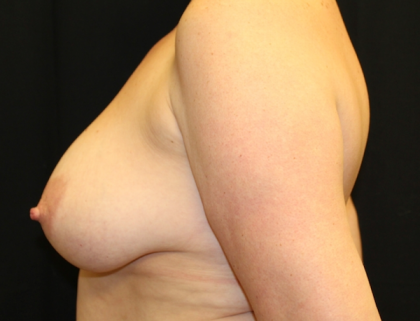 Breast Reduction Before & After Patient #30667