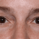 Blepharoplasty Before & After Patient #30729