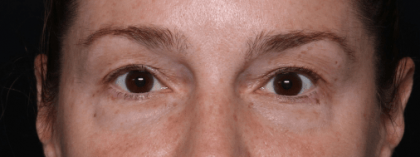 Blepharoplasty Before & After Patient #30729