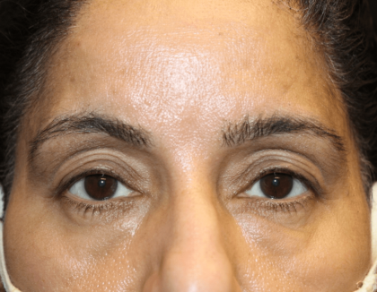 Blepharoplasty and Brow Lift Before & After Patient #30696