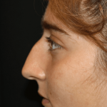 Rhinoplasty Before & After Patient #30832