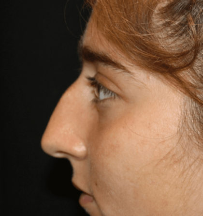 Rhinoplasty Before & After Patient #30832