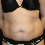 Tummy Tuck Before & After Patient #30841