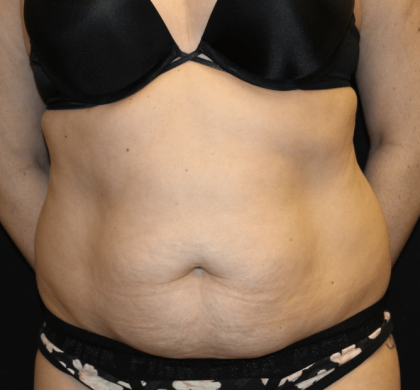 Tummy Tuck Before & After Patient #30841