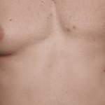 Gynecomastia Before & After Patient #30854